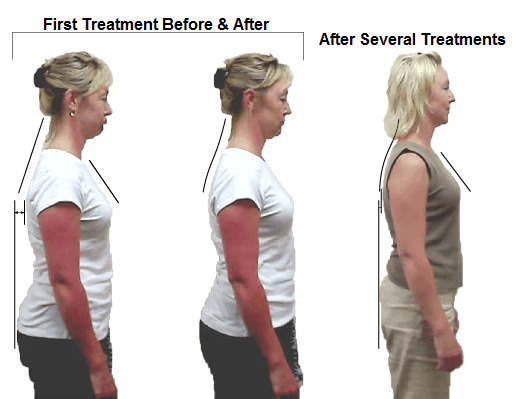 A female chiropractor near me can help improve posture and relieve back pain. - Upright Posture