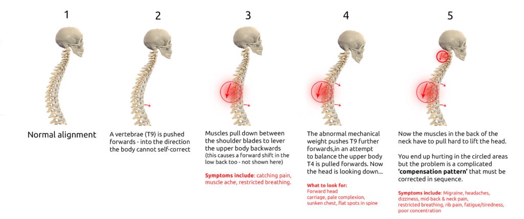 An illustrated sequence showing spinal misalignment progression, highlighting vertebrae shifts, compensation patterns, and associated symptoms.