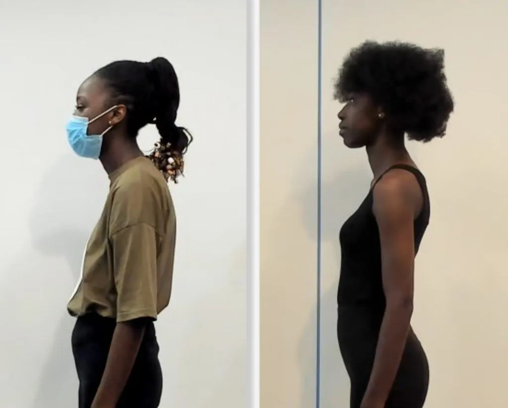 A before-and-after comparison showcasing improved posture, highlighting the benefits of visiting a local chiropractor for spinal alignment and posture correction.