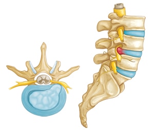 Herniated disc
