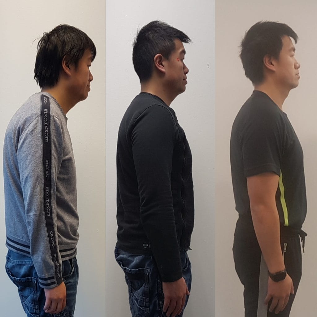 Side-by-side comparison of a man’s posture before and after treatment, showing noticeable improvements in spinal alignment and head position.